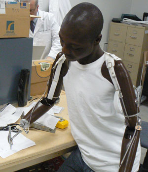conventional body powered prosthesis